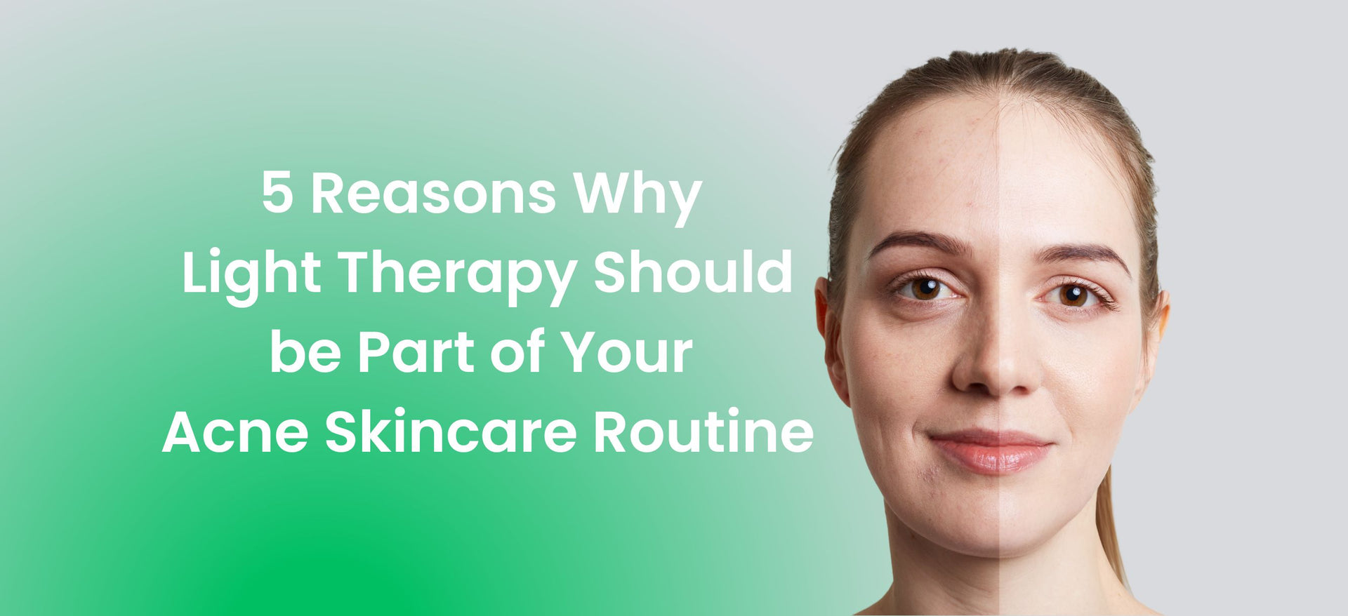 5 Reasons Why Light Therapy Should be Part of Your Acne Skincare Routine