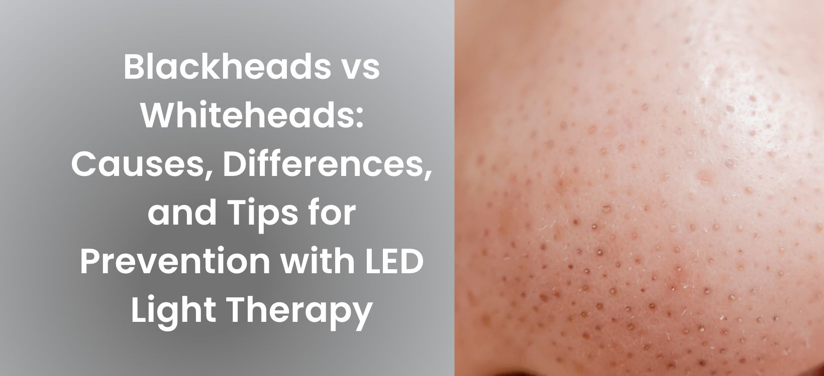 Blackheads vs Whiteheads: Causes, Differences, and Tips for Prevention with Led Light Therapy