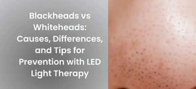 Blackheads vs. Whiteheads: Causes, Differences, and Tips for Prevention with LED Light Therapy