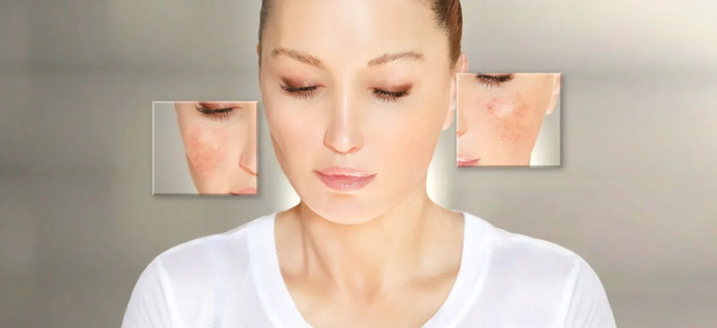LED Therapy for Rosacea
