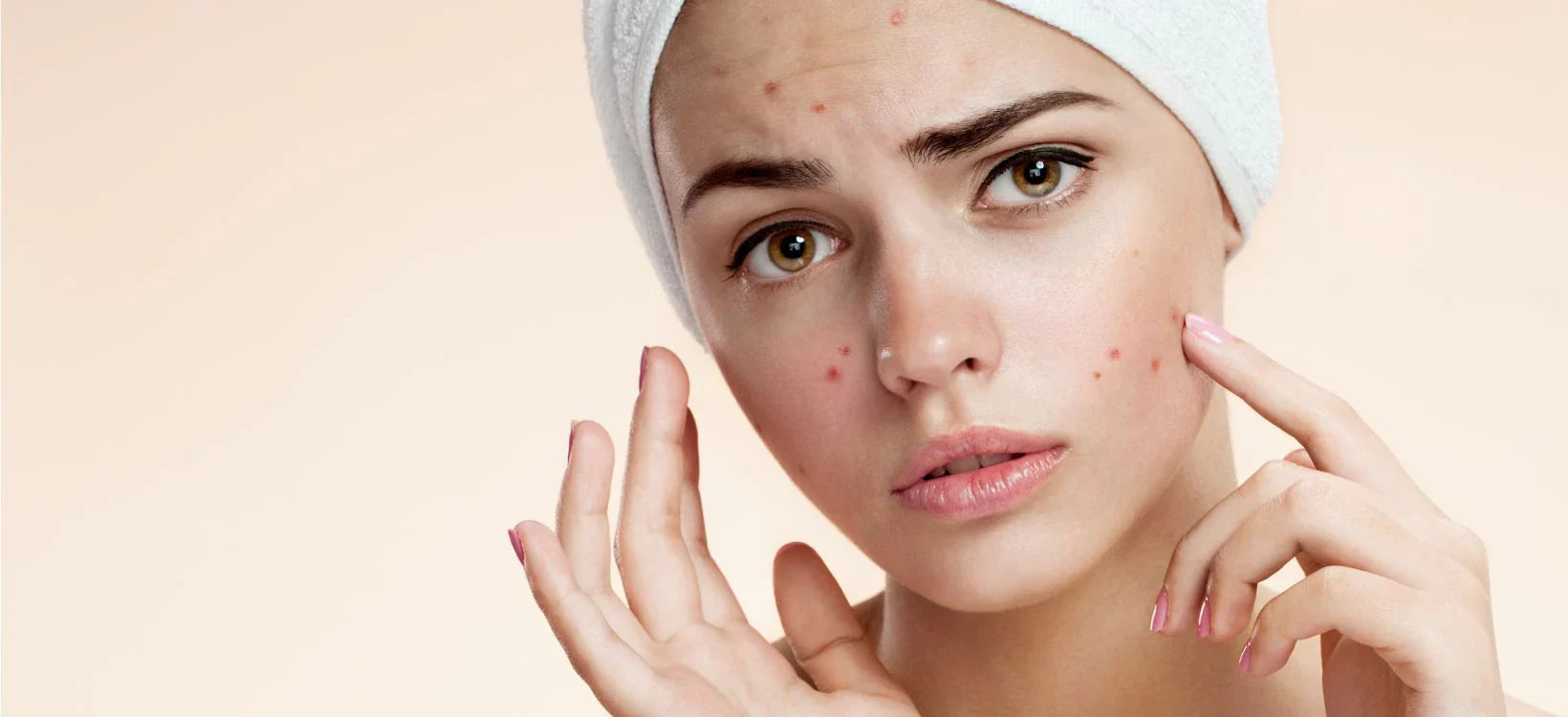 Young woman with acne spots examining her skin, wearing a white headband.