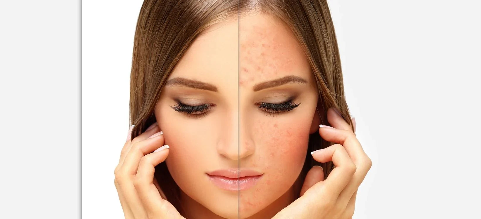 Comparison image of a woman's face showing clear skin on one side and facial redness and blemishes on the other side, highlighting effects of skin conditions like rosacea or acne.