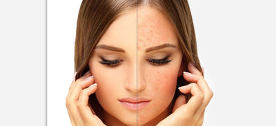 How to Reduce Redness on your face with LED therapy