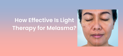 How Effective Is Light Therapy for Melasma?