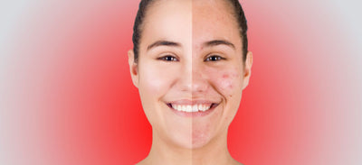 LED Therapy: Benefits for Acne-prone Skin