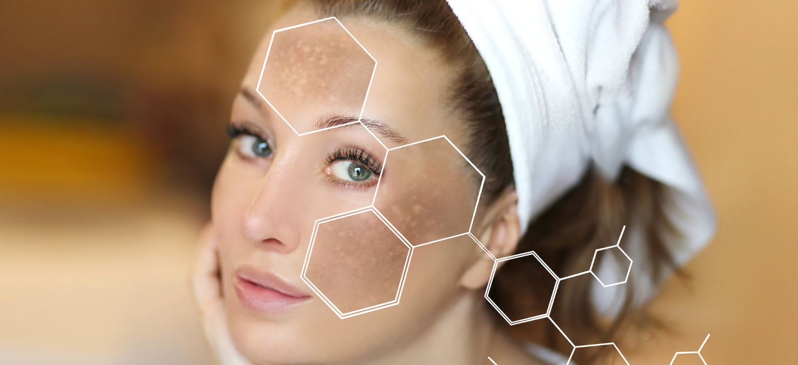 Light therapy for hyperpigmentation