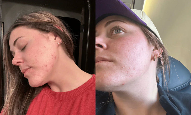 Acne Spot Treatment That Works: Kalli’s 6-Week Journey