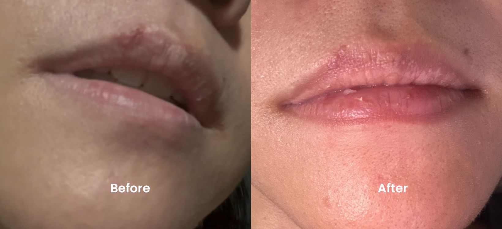 LED Esthetics Lip Wand Before and after