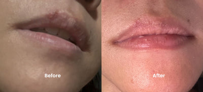 How I Treated My Cold Sore with the Glotech™ Lip Wand: A 3-Day Journey