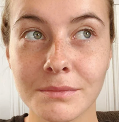 Client after using LED Esthetics
