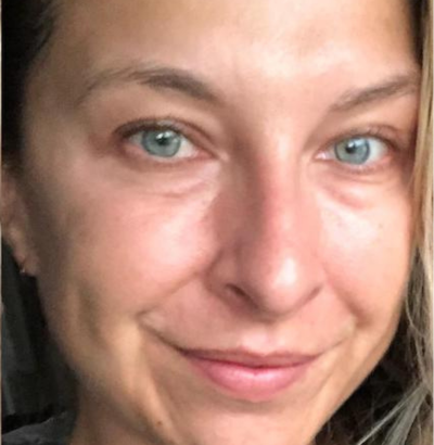 Client after using LED Esthetics