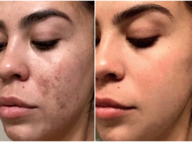 Before and after comparison of a person's face with acne on the left and clear skin on the right.