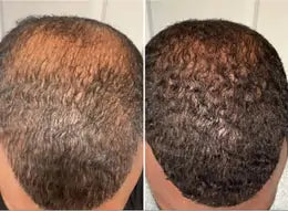Before and after comparison of hair growth on a person's head.