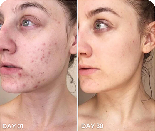 Eliminate Acne