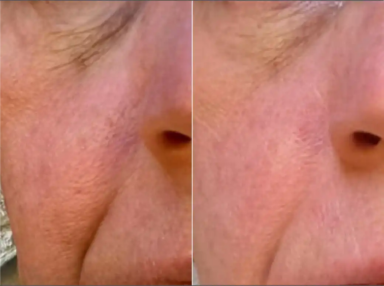 Cherise, 65 before and after using Huge difference in 7 days