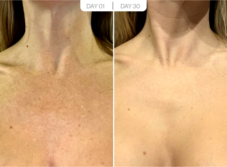 Veronica, 34 before and after using Sun damage gone!