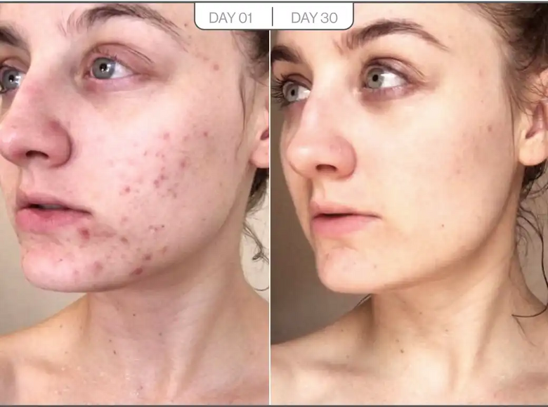 Iggie, 39 before and after using Worth the money