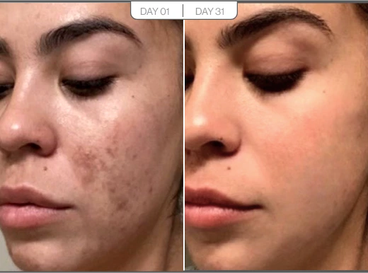 Adriana, 38 before and after using My skin is glowing!