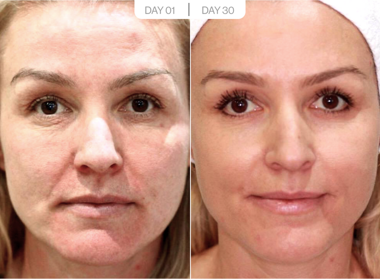 Lisa, 47 before and after using Better than laser