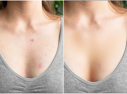 Tami J, 61 before and after using No more chest acne