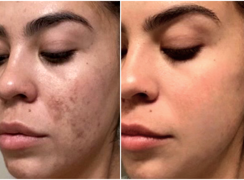 Adriana, 38 before and after using Why didn't I get this sooner?