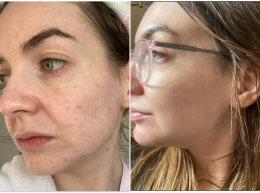 MK, 41 before and after using Finally clear skin
