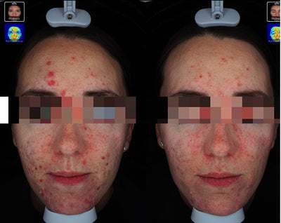 Before-after
