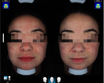Before-after