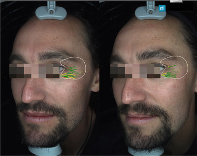 Before-after