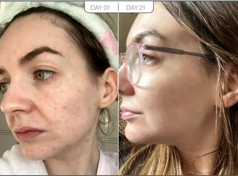 MK, 41 before and after using Finally clear skin
