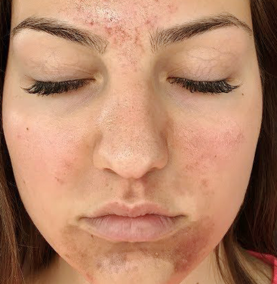 Client before using LED Esthetics