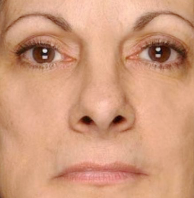 Client after using LED Esthetics