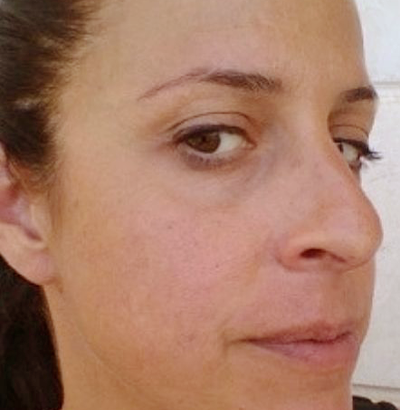 Client after using LED Esthetics