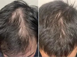 Before and after comparison of hair growth on a person's head.