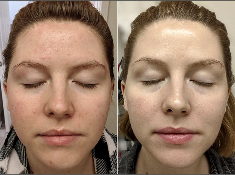 Kayla, 32 before and after using Make-up free