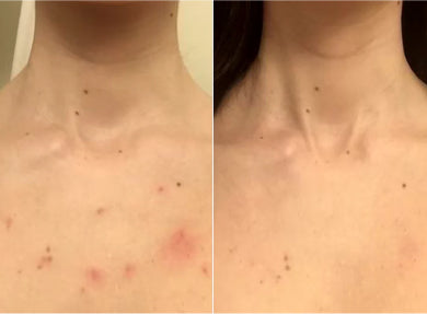 Before and after comparison of skin with visible blemishes on a person's neck.