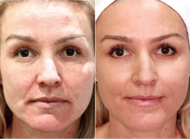 Before and after comparison of a woman's face with visible skin improvement.