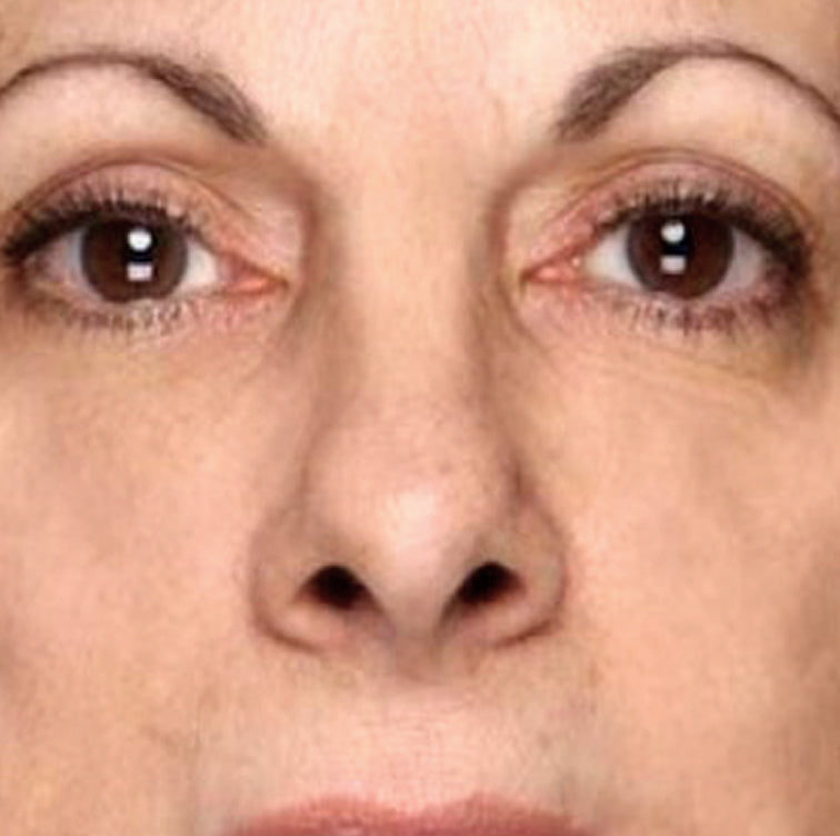 Marge, 68 after using LED Esthetics