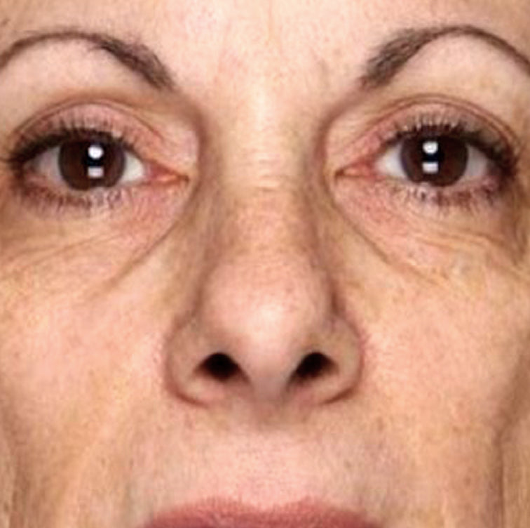 Marge, 68 before using LED Esthetics