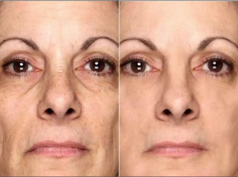 Marge, 68 before and after using Results after 5 weeks