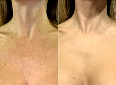 Veronica, 32 before and after using Sun damage gone!!