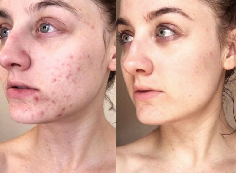 Iggie, 39 before and after using 5-stars, hands down