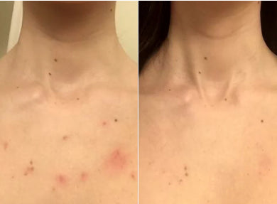 Kelli, 29 before and after using Finally clear skin