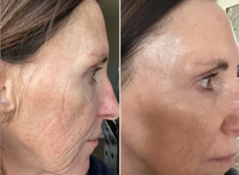 Tami J, 61 before and after using WOW!