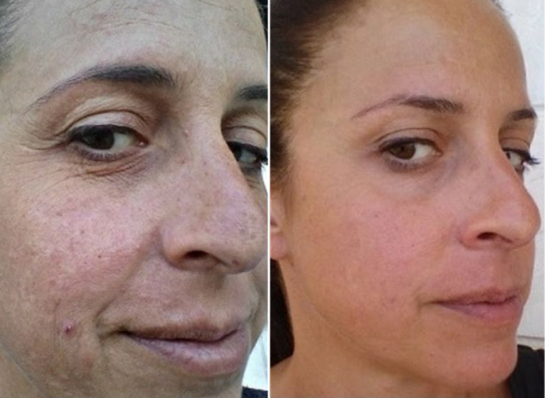 Jessie, 45 before and after using Skin saver