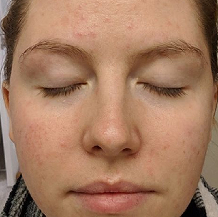 Kayla, 32 before using LED Esthetics