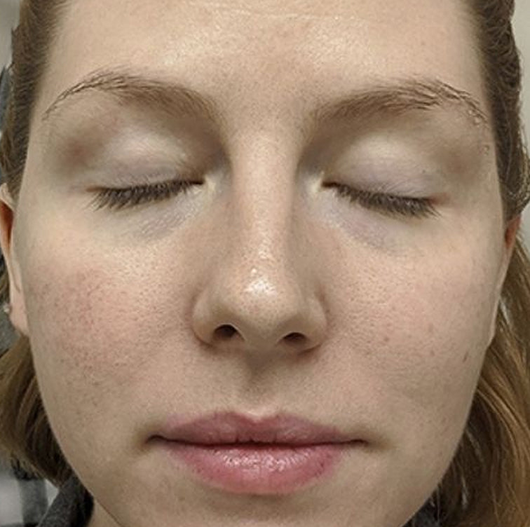 Kayla, 32 after using LED Esthetics
