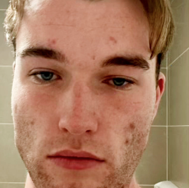 Tyler, 29 before using LED Esthetics