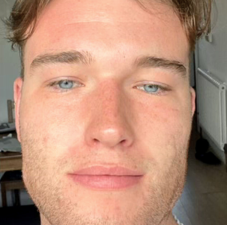 Tyler, 29 after using LED Esthetics