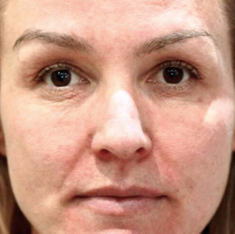 Lisa, 47 before using LED Esthetics